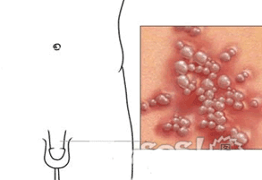 男性生殖器疱疹症状图