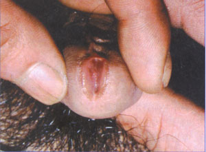 非淋性尿道炎的症状