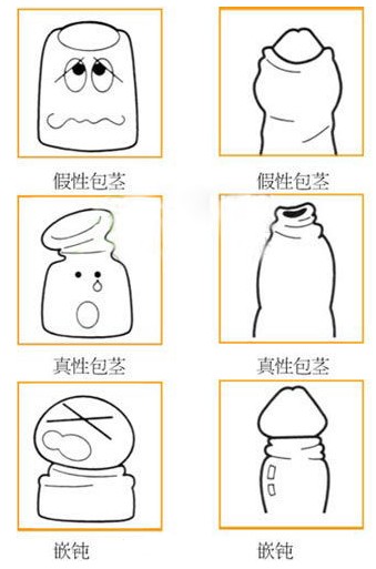如何区分包皮过长与包茎