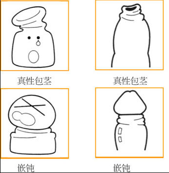嵌顿性包茎图片