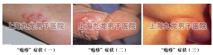 生殖器疱疹为何易反复?